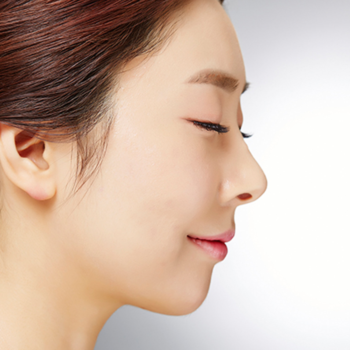 필러 시술 후 뭉침현상, 해결 방안은? 썸네일 이미지
