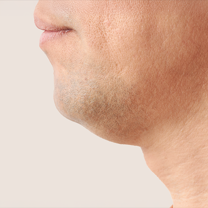 50대, 일본 고객님의 안면거상 전후 사진입니다. 썸네일 이미지