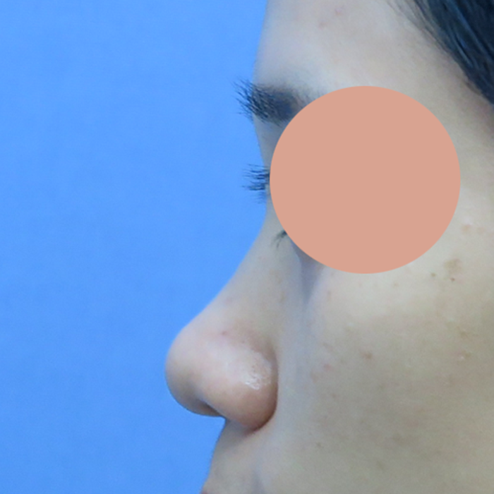 Có Thể Nâng Mũi Cao Bao Nhiêu Khi Phẫu Thuật Mũi? Thumbnail