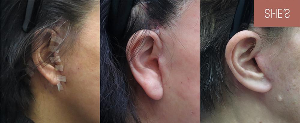 手術成果離不開術後的細心照顧！